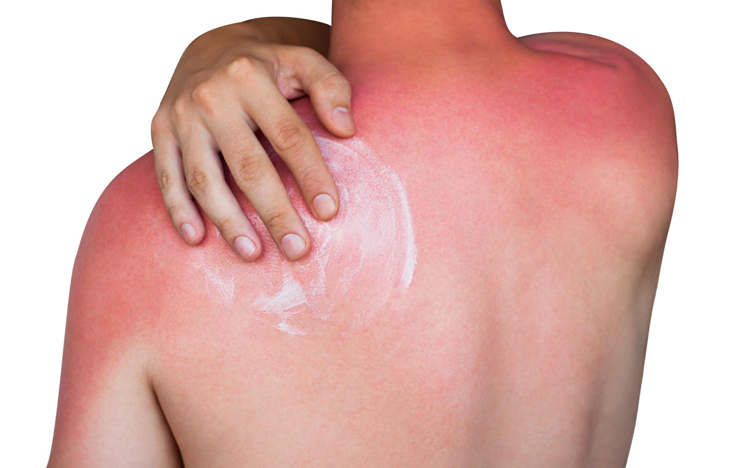 Sonnenbrand