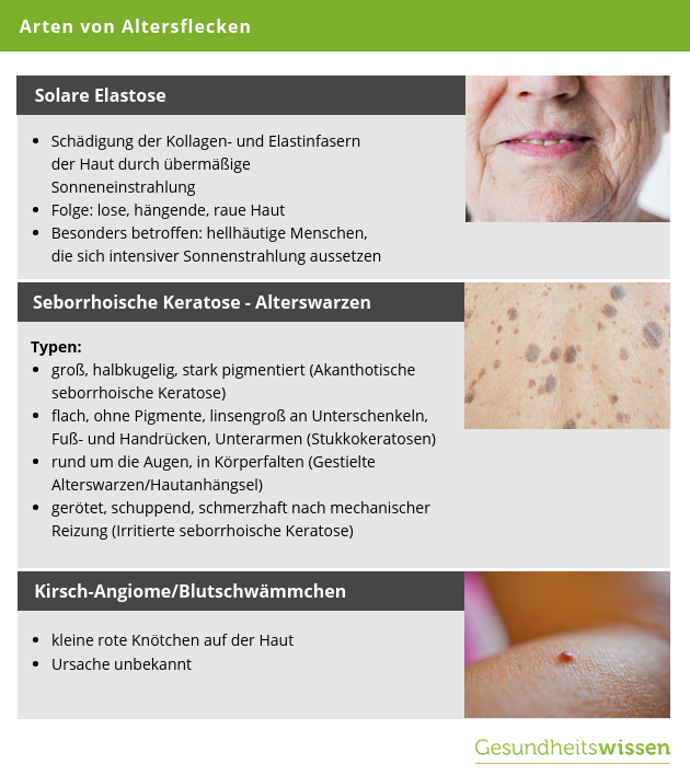Arten von Altersflecken