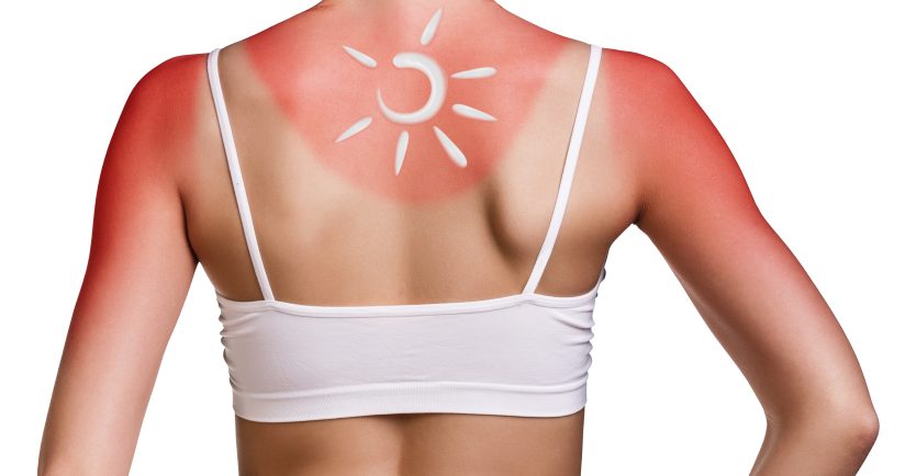 Behandeln Sie Sonnenbrand schnell & richtig