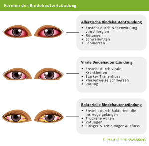 Bindehautentzündung: Symptome, Ursachen & Behandlungen