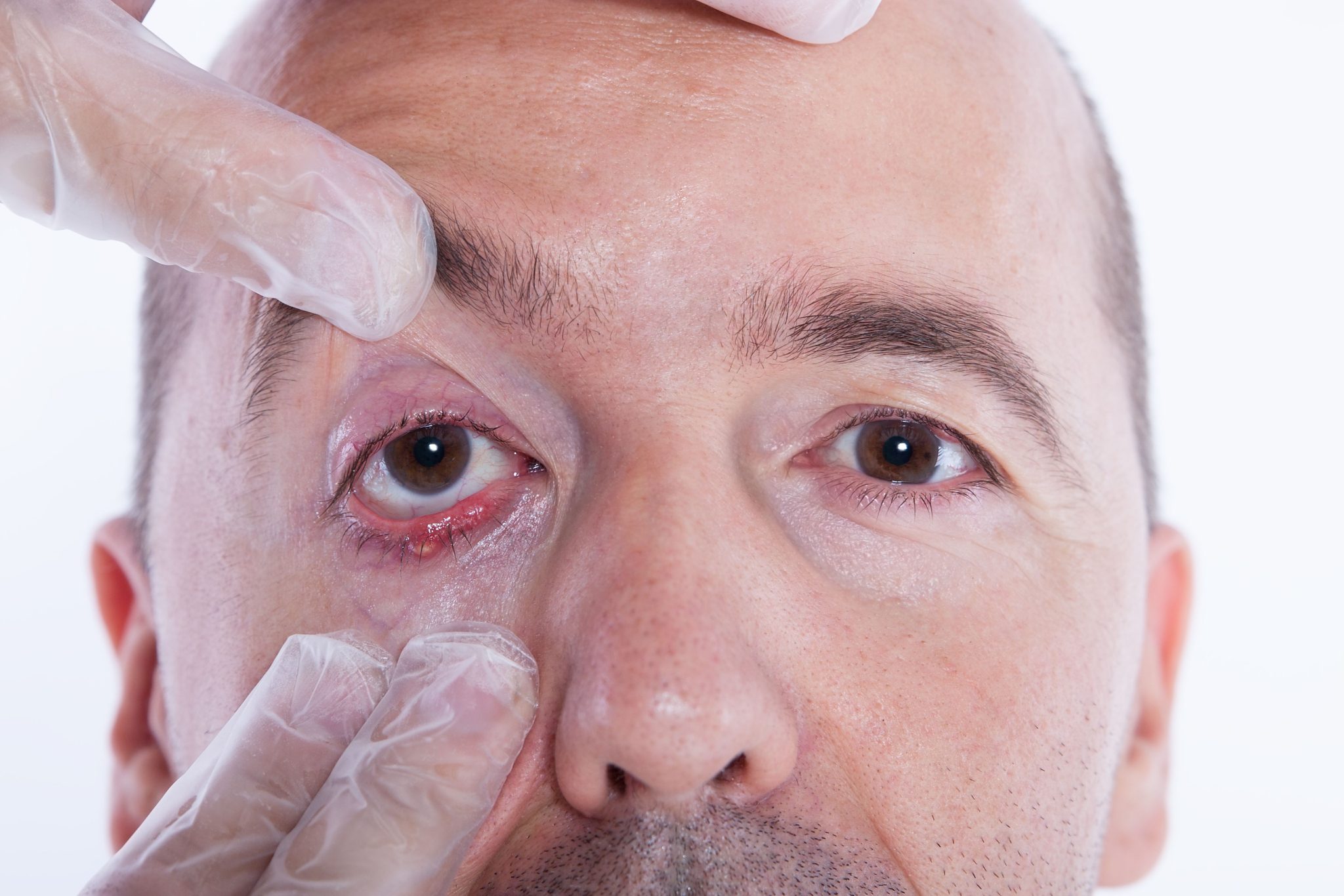 Salbe Gegen Gerstenkorn Am Auge www.gesundheitswissen.de