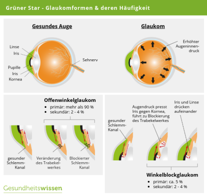 Grner Oder Grauer Star