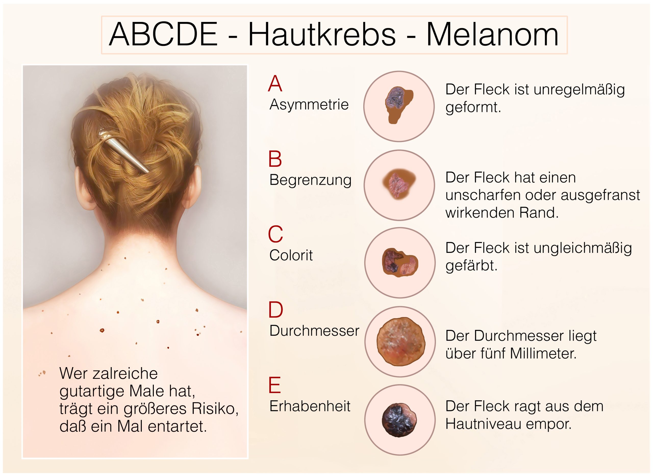 Früherkennung ist der Schlüssel, achten Sie daher verschärft auf verdächtig aussehende Male an Ihrem oder den Körpern Ihrer Liebsten.