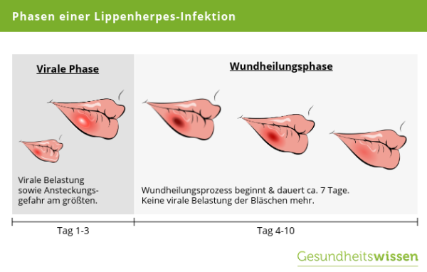 Die wichtigsten Grundlagen zum Thema Herpes | Ursachen & Behandlung