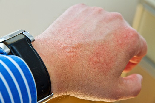 Nesselsucht – Ursachen, Symptome, Diagnose & Behandlung