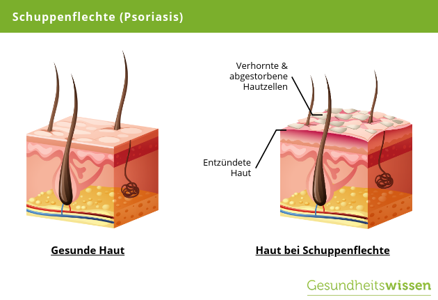 Schuppenflechte