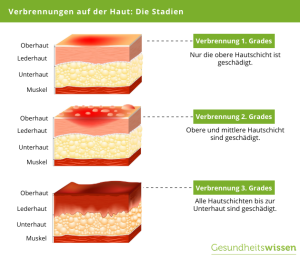 Was tun bei Verbrennung? So handeln Sie richtig