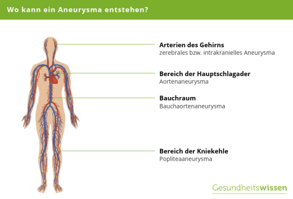 Was Darf Man Bei Aneurysma Nicht Machen www.gesundheitswissen.de