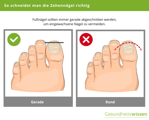 Eingewachsene Fußnägel – Diagnose, Behandlung & Vorbeugung