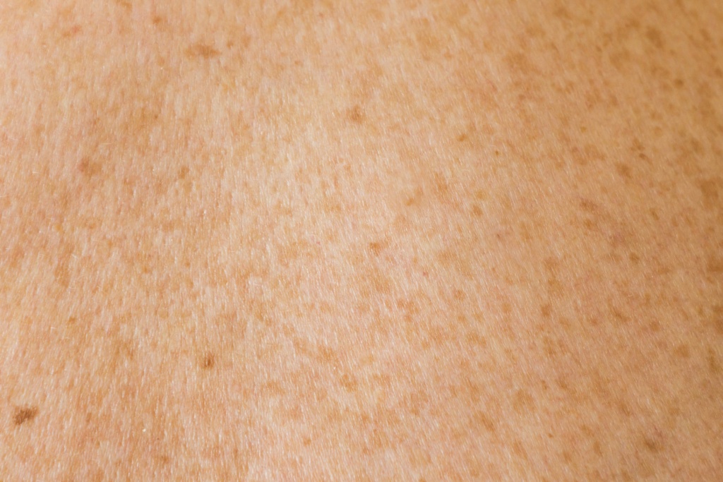 eine Nahaufnahme des Rückens einer Person mit braunen Flecken