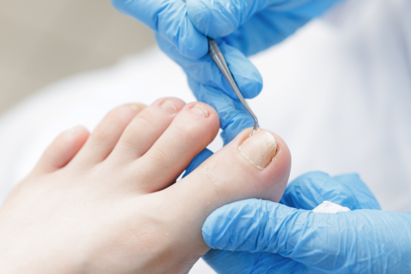 Effektive Behandlung von Nagelpilz: Welche Mittel wirklich helfen