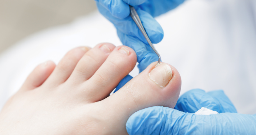 Behandlung von Nagelpilz